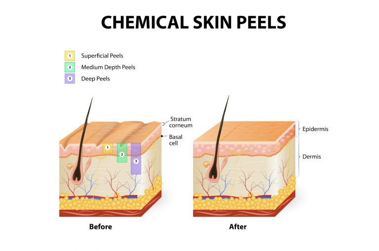 Chemical Skin Peels Diagram