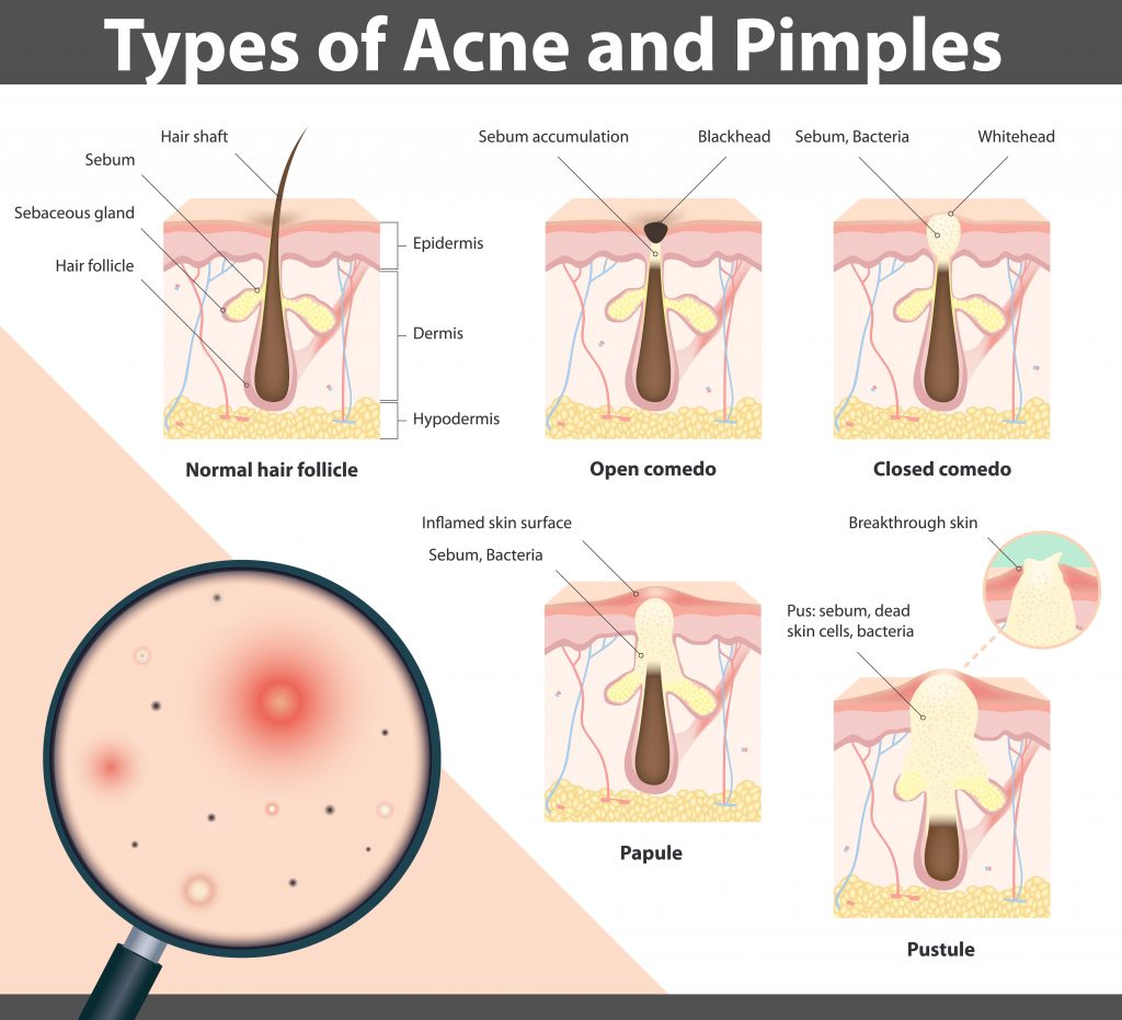 Types of Acne Diagram
