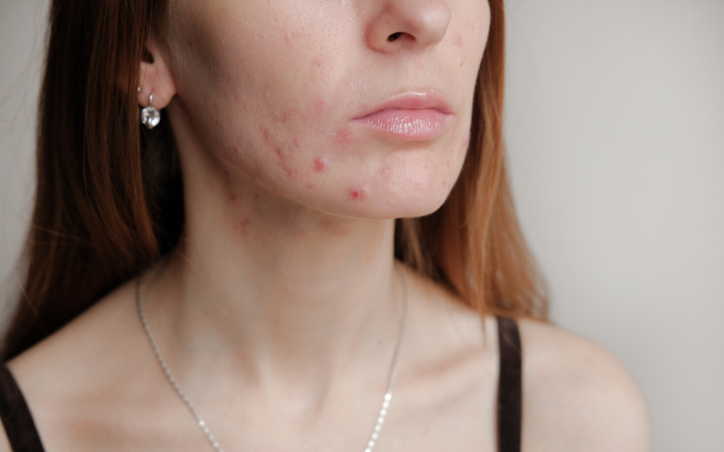 hormonal-acne-treatments