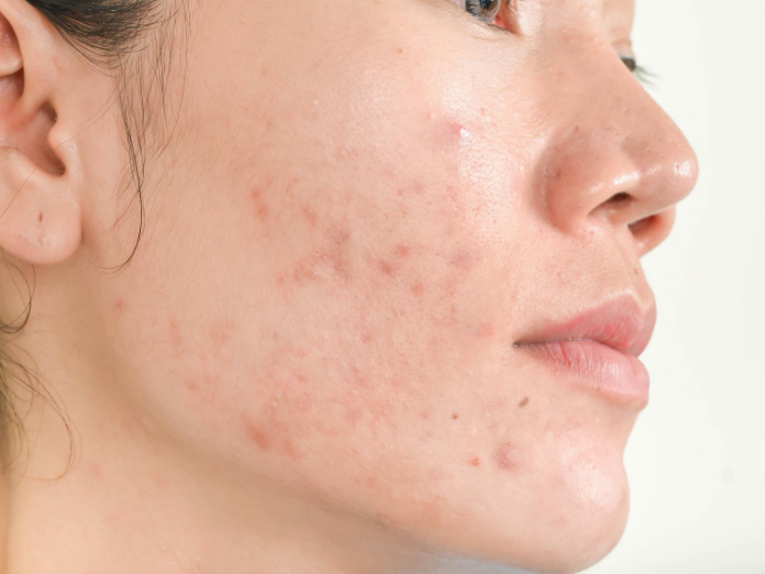 does metformin cause cystic acne