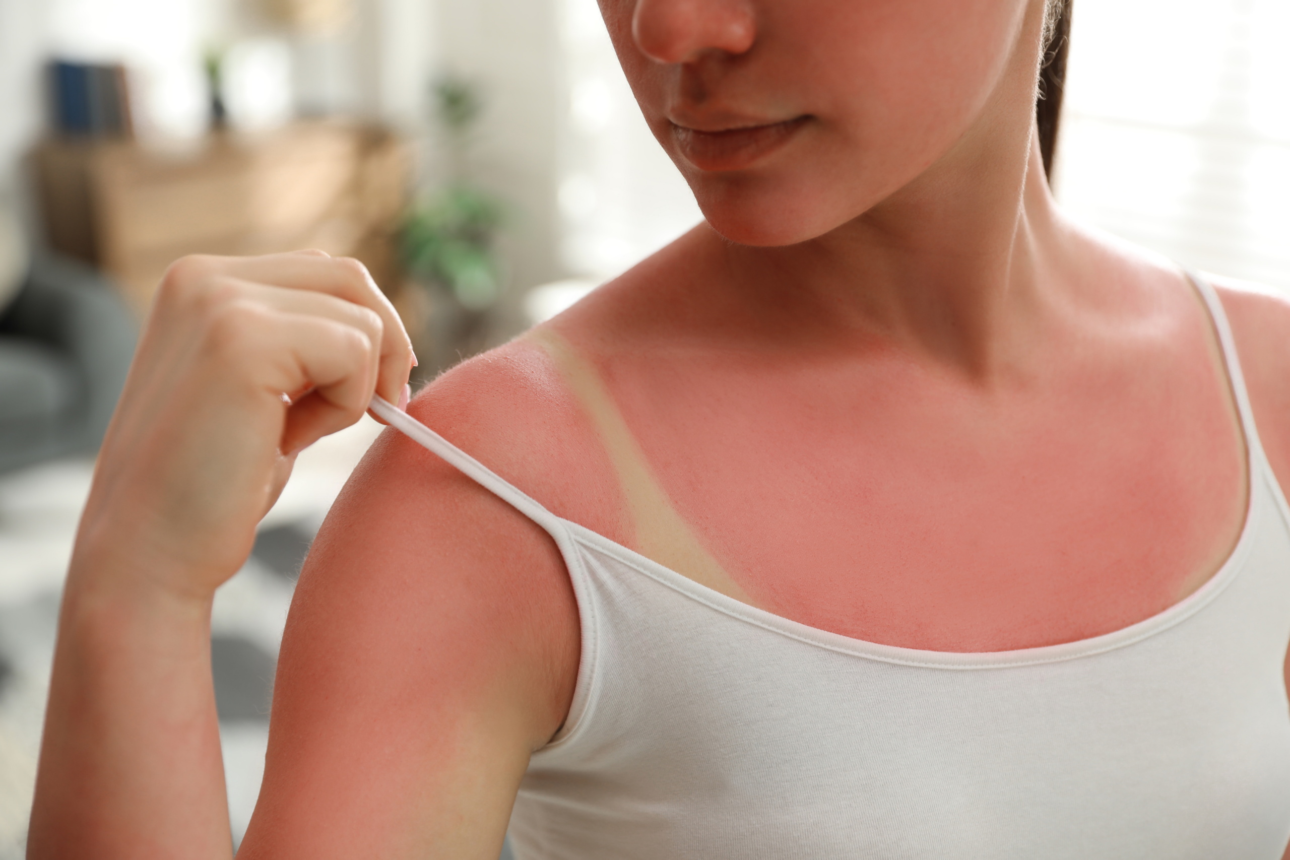 Dive into the world of natural sunburn remedies and experience the nur